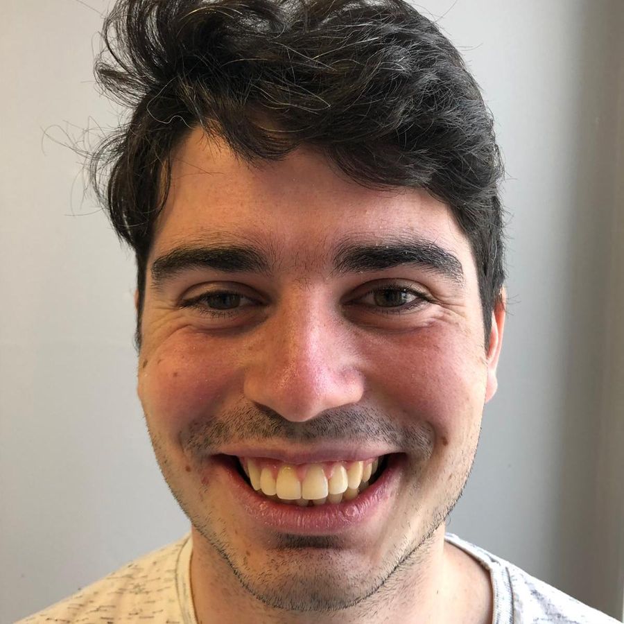 6 month braces - after - 3Dental